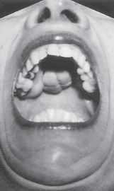 <figcaption>Torus palatinus, a bony, lobulated outgrowth typically found in the hard palate of people with a particular LRP5 mutation. Credit: © 2002 MASSACHUSETTS MEDICAL SOCIETY</figcaption>